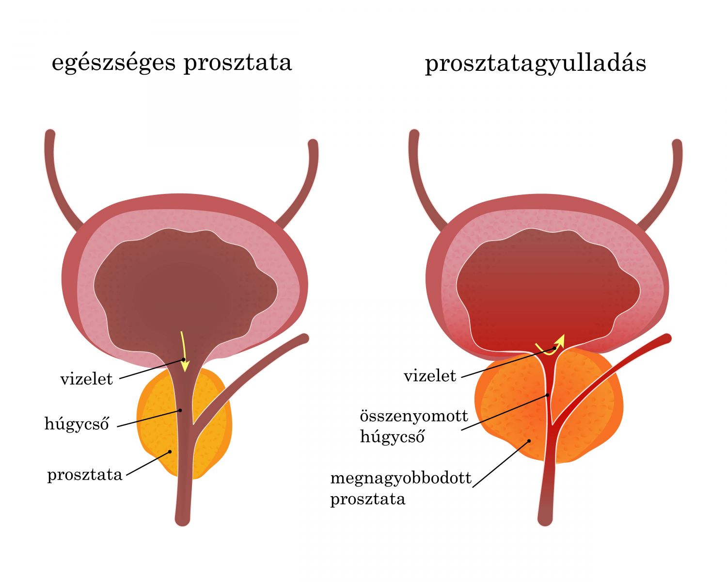 Krónikus prosztatagyulladás gyógynövényekkel történő kezelése, A prosztatagyulladás tünetei